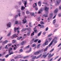 follicular lymphoma 200x200