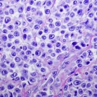 mantle cell lymphoma