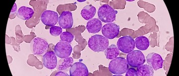 Acute Myeloid Leukemia under microscope