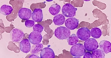 Acute Myeloid Leukemia under microscope