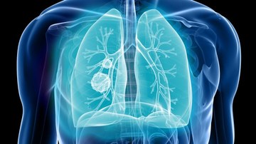 Early-Stage Non-small Cell Lung Cancer