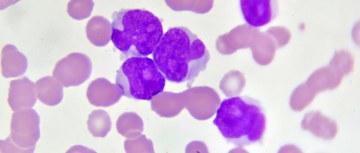 An image of Acute Myeloid Leukemia cells