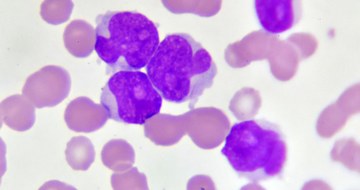 An image of Acute Myeloid Leukemia cells