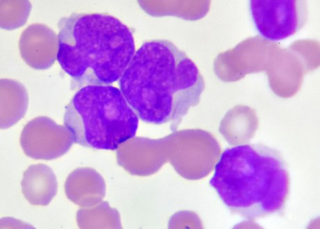 An image of Acute Myeloid Leukemia cells