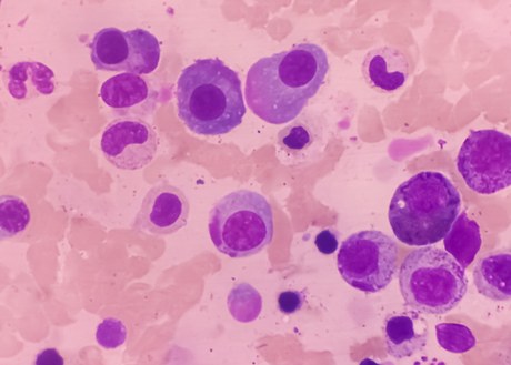 An image of multiple myeloma cells