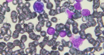 An image of acute lymphoblastic leukemia cells