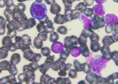 An image of acute lymphoblastic leukemia cells