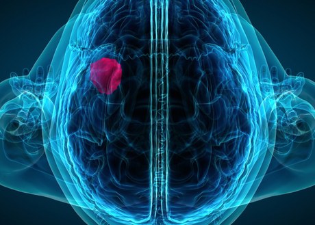 An image of a brain x-ray