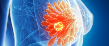 Image of breast cancer