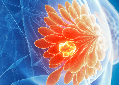 Image of breast cancer