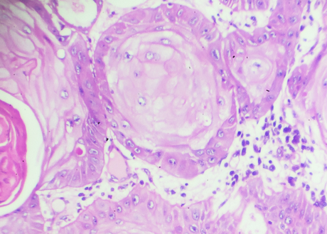Squamous cell carcinoma