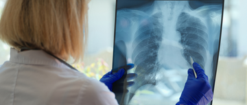 Lung cancer x-ray image