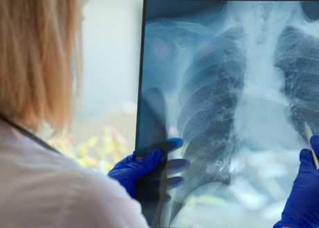 Lung cancer x-ray image