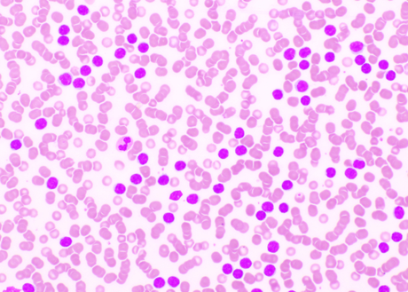 acute leukemia image