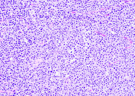 Diffuse large B-cell lymphoma