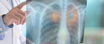 An image of a doctor looking at an x-ray of lungs with cancer