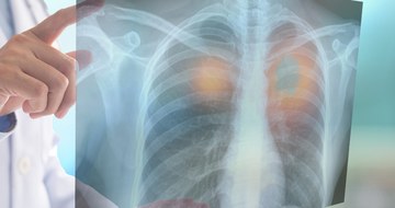 An image of a doctor looking at an x-ray of lungs with cancer