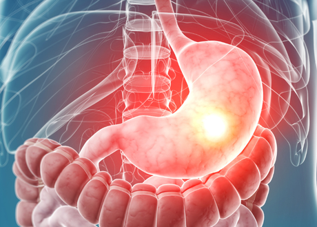 stomach cancer image