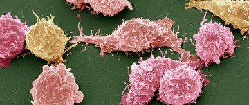 metastatic non-small cell lung cancer