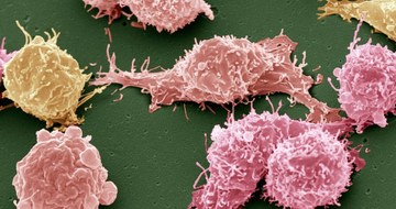 metastatic non-small cell lung cancer