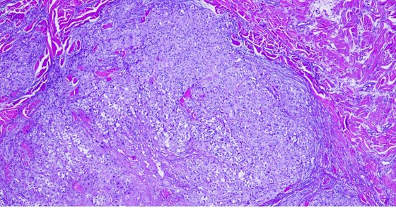 uveal melanoma with unresectable hepatic metastases