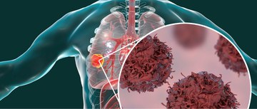-positive non-small cell lung cancer