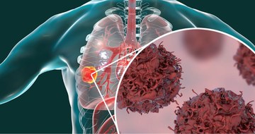 -positive non-small cell lung cancer