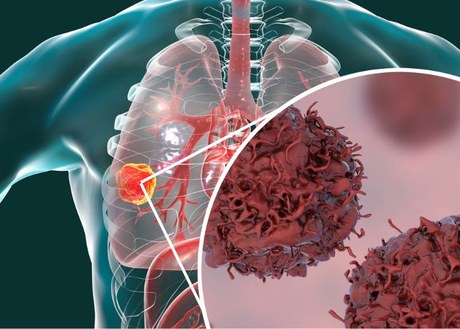 -positive non-small cell lung cancer