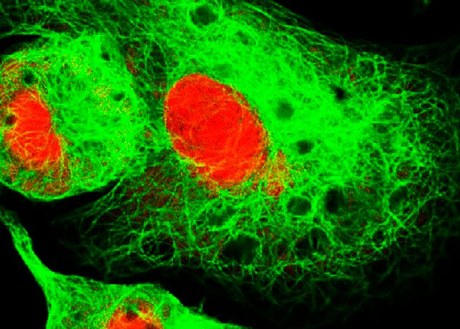 high-risk neuroblastoma