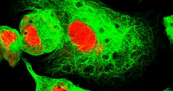 high-risk neuroblastoma
