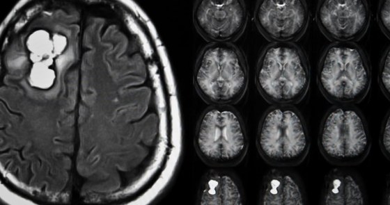 X-ray of brain with desmoid tumors