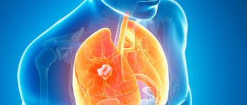 digital medical illustration of lung cancer in a person's chest