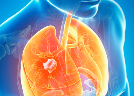 digital medical illustration of lung cancer in a person's chest