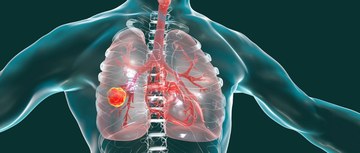 Imaging scan of lung cancer