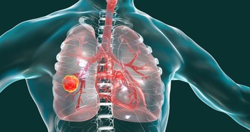 Imaging scan of lung cancer